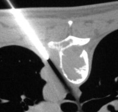 Aggressive vertebral hemangioma of the thoracic spine without typical