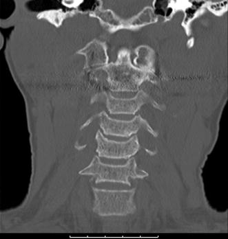 Spondylolisthesis surgery image
