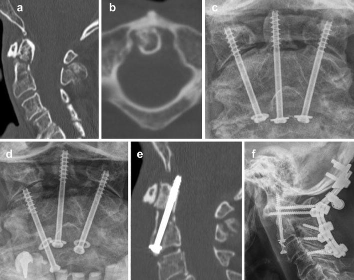 icd 10 odontoid fracture icd 10 odontoid fracture