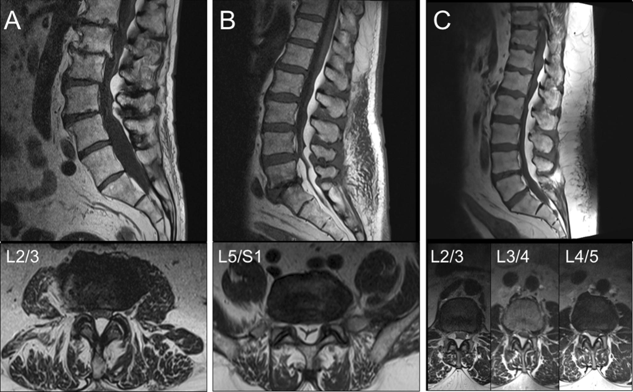 Lipomatosis | Sitelip.org