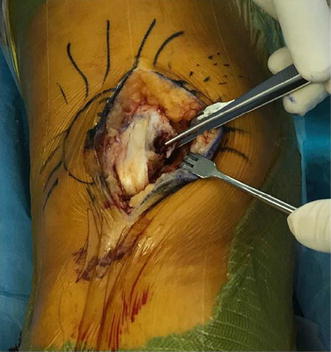 A new minimally invasive surgical technique for medial ...