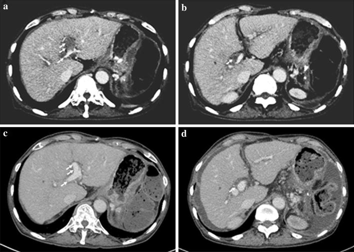 Catheterdirected continuous thrombolysis following aspiration