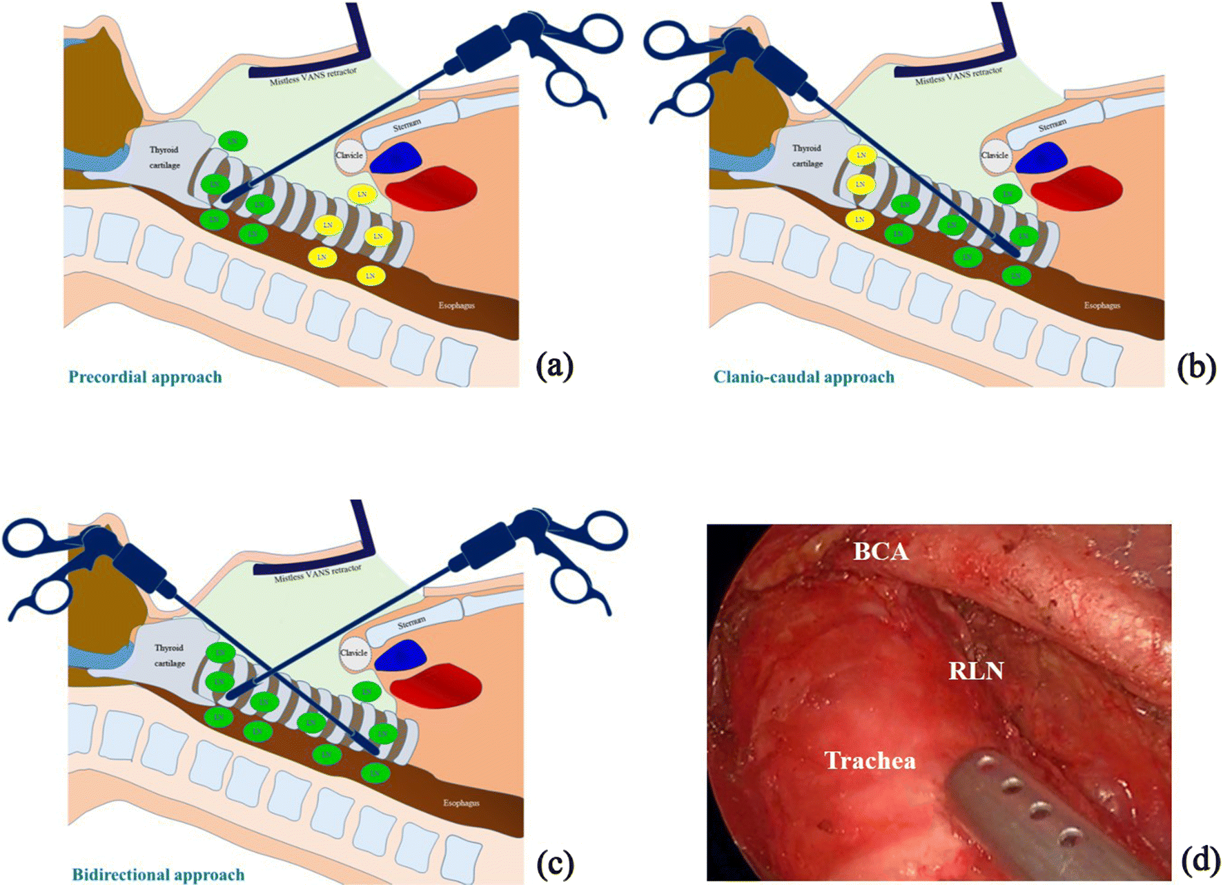 Upgraded bidirectional approach videoassisted neck surgery (BAVANS