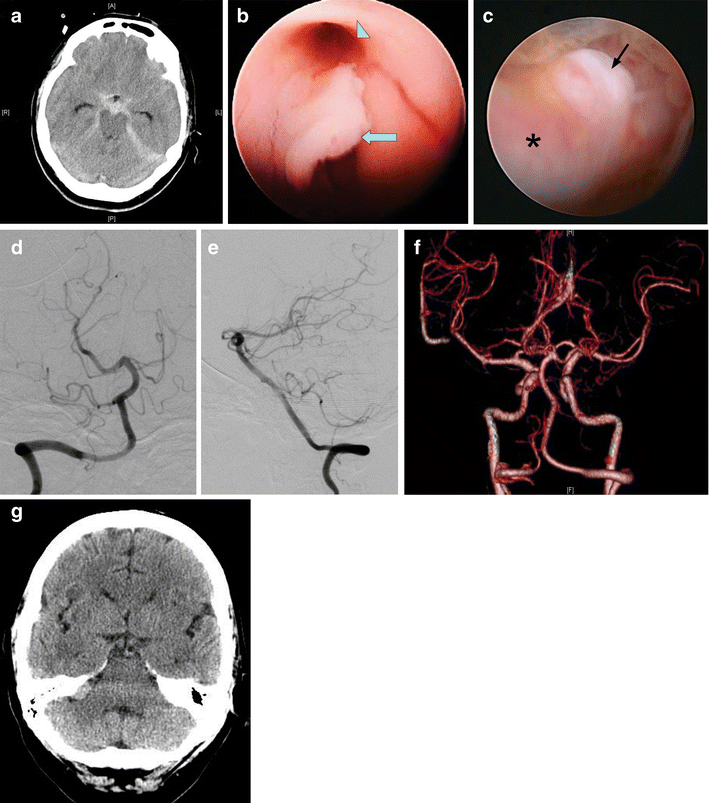 Endoscopic third ventriculostomy for hydrocephalus after