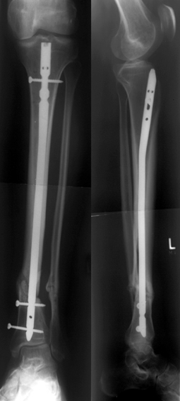 Trauma des Unterschenkels und des oberen Sprunggelenks | SpringerLink