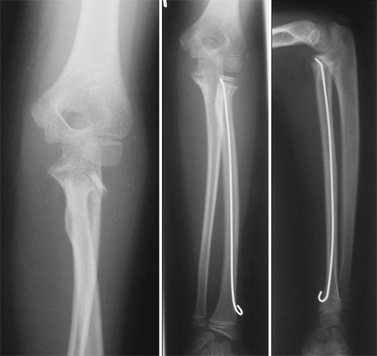 Proximale Unterarm- und Radiushalsverletzungen beim Kind ...