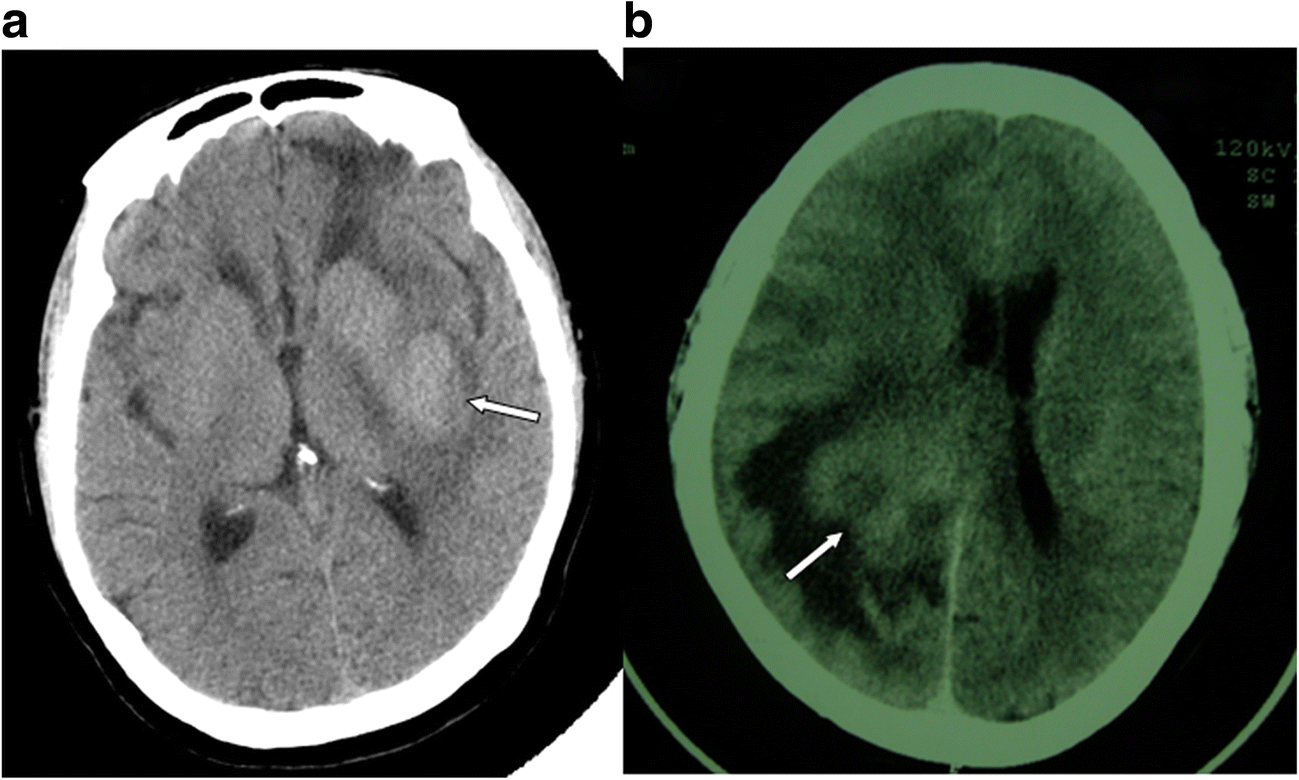 Imaging features (CT, MRI, MRS, and PET/CT) of primary central nervous ...