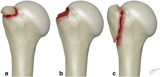 Isolated greater tuberosity fractures of the proximal humerus: anatomy