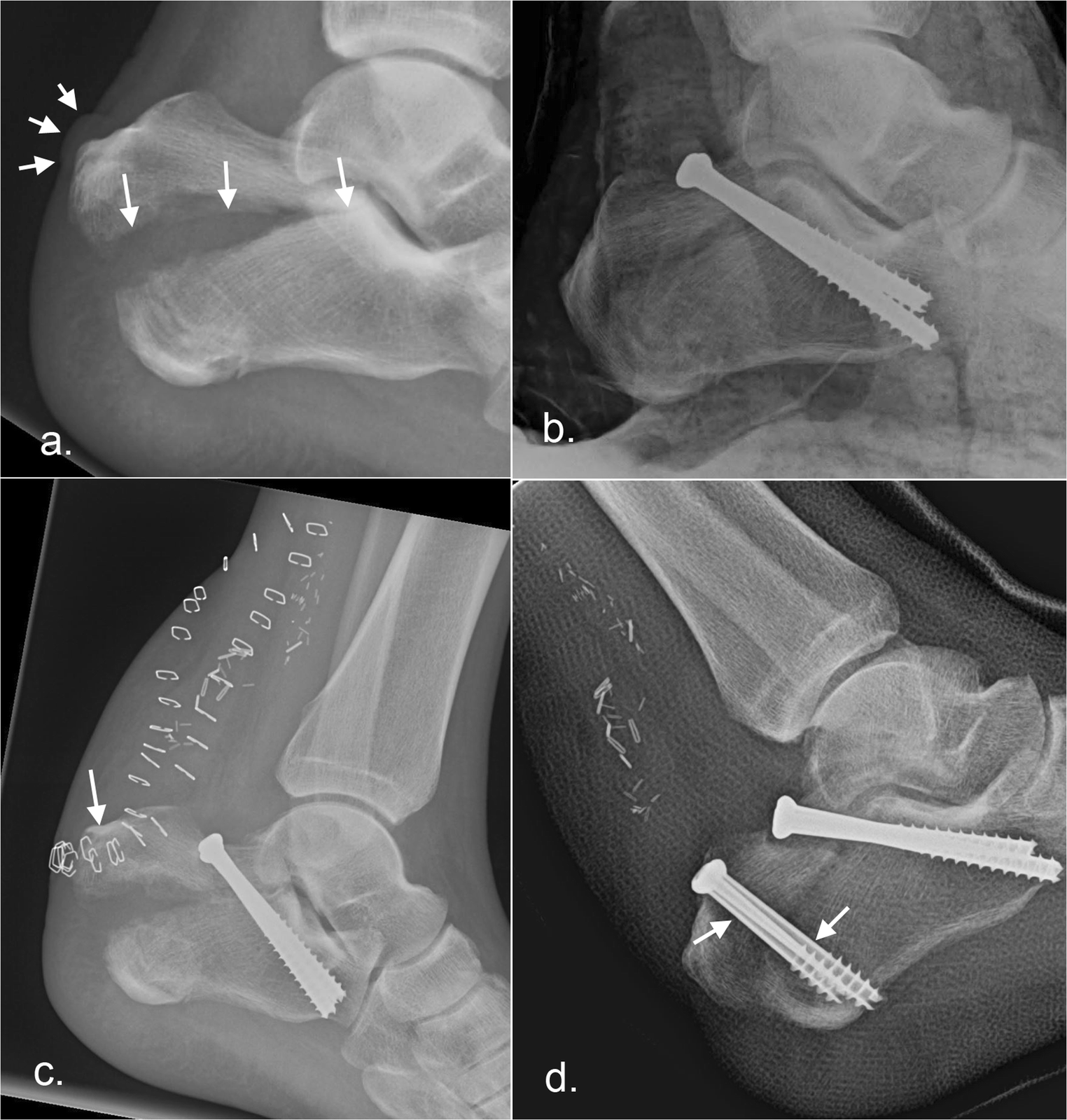 calcaneus fracture