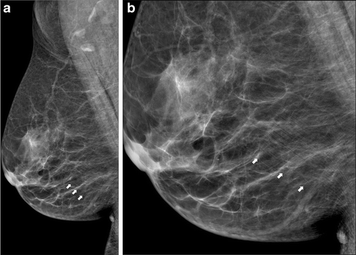 Mammographic Artifacts on Full-Field Digital Mammography | Springer for ...