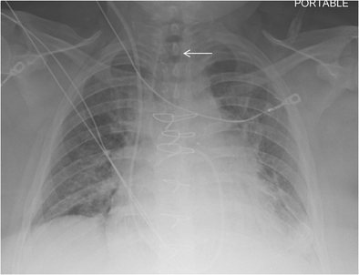 Deep Convolutional Neural Networks for Endotracheal Tube Position and X ...