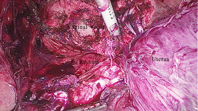 Laparoscopic hysterectomy in frozen pelvis—an alternative ... frozen pelvis diagram 