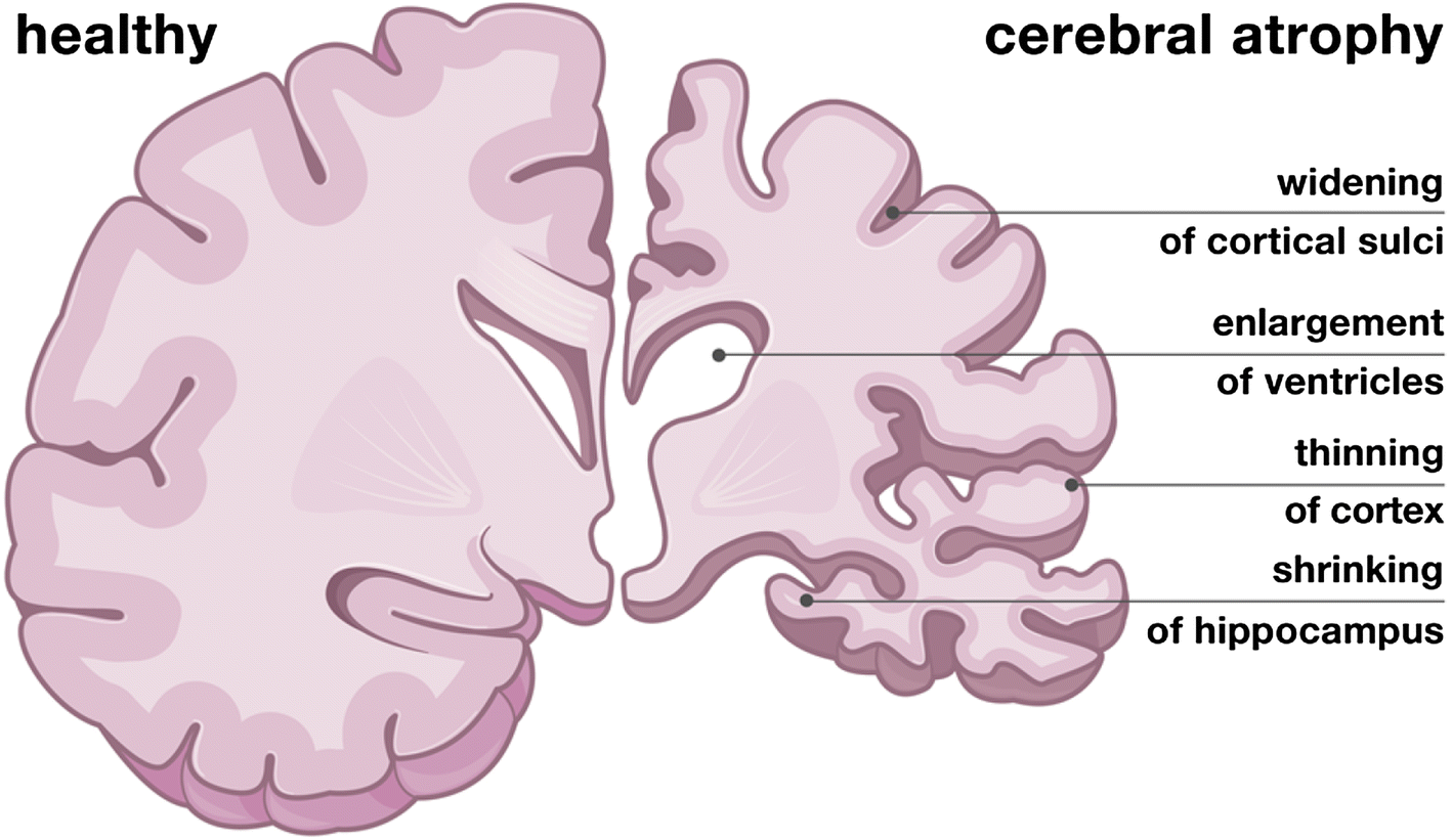 The Shrinking Brain: Cerebral Atrophy Following Traumatic Brain Injury