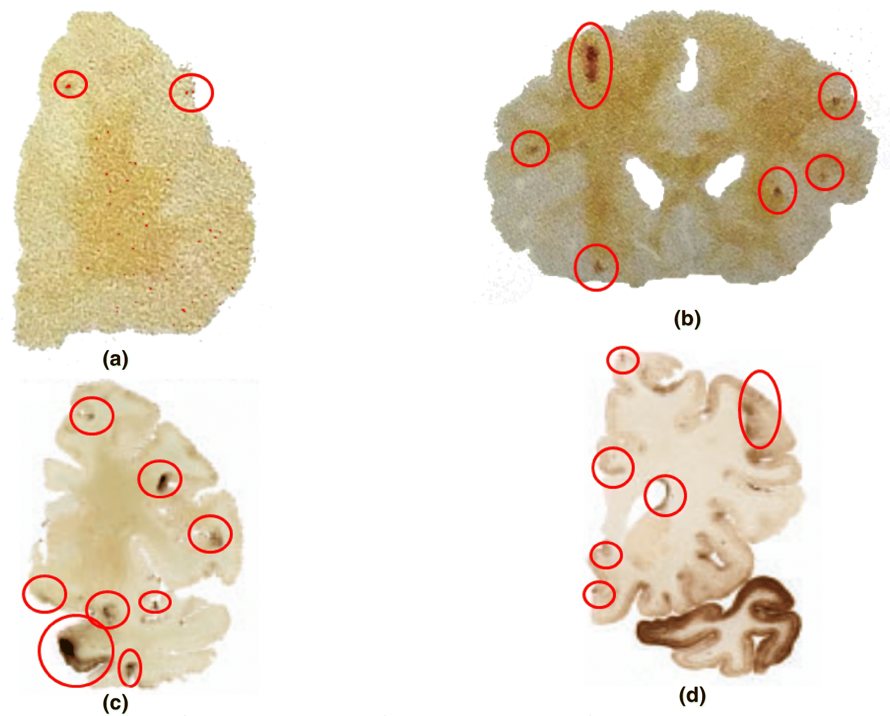 A Mechanical Brain Damage Framework Used to Model Abnormal Brain Tau