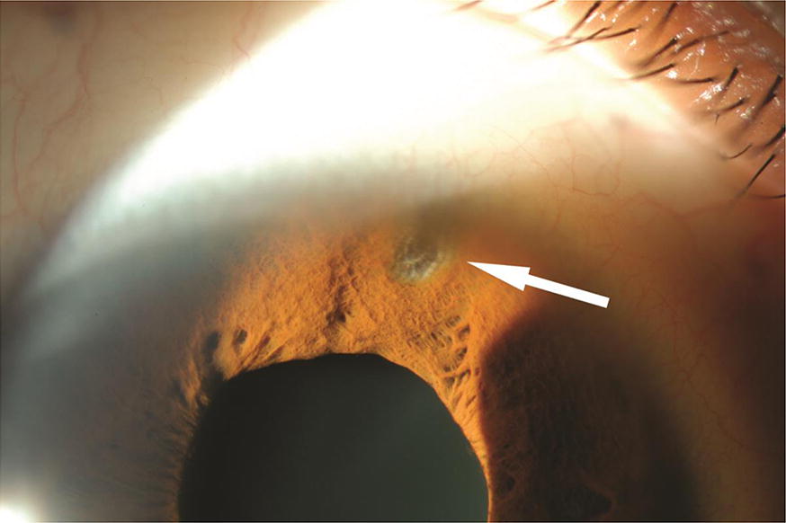 Clinical features of anterior uveitis caused by three different herpes