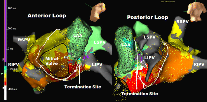 right atrial flutter ablation right atrial flutter ablation