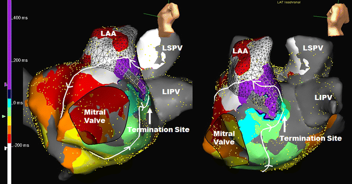 right atrial flutter ablation right atrial flutter ablation