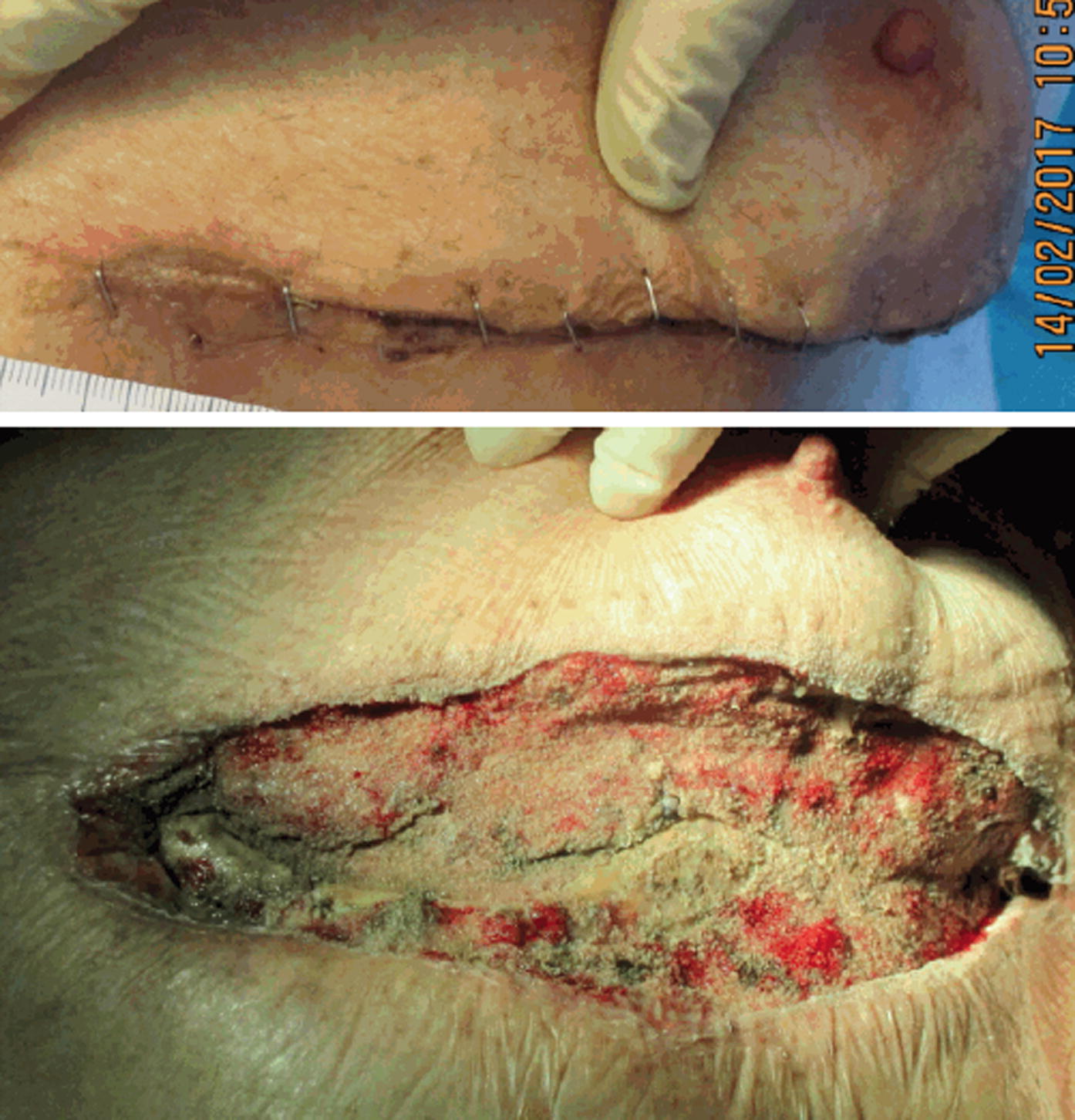 Invasive Fungal Infection Caused by Exophiala dermatitidis in a Patient