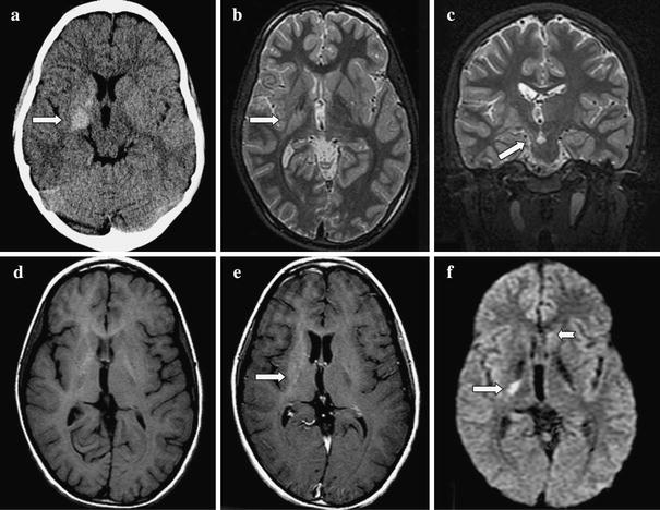 Inherent diagnostic and treatment challenges in germinoma of the basal ...