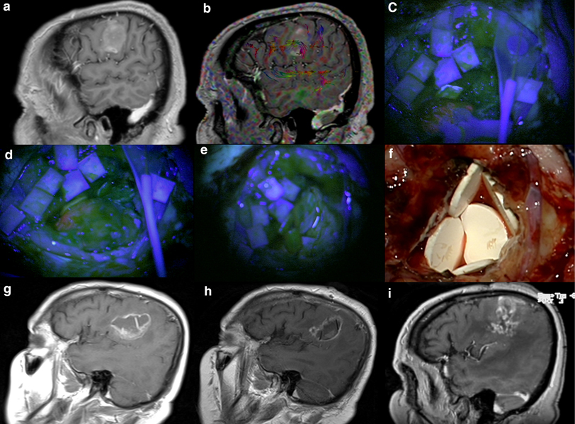 of patients affected by newly diagnosed glioblastoma undergoing