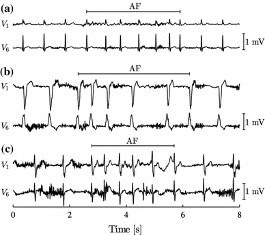 icd 10 for paroxysmal atrial fibrillation icd 10 for paroxysmal atrial fibrillation