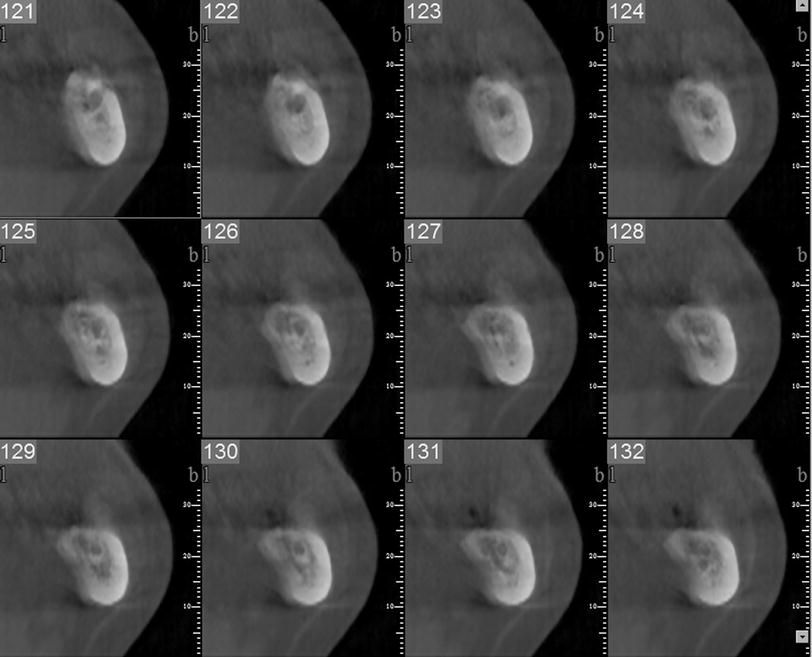 Metal and motion artifacts by cone beam computed tomography (CBCT) in