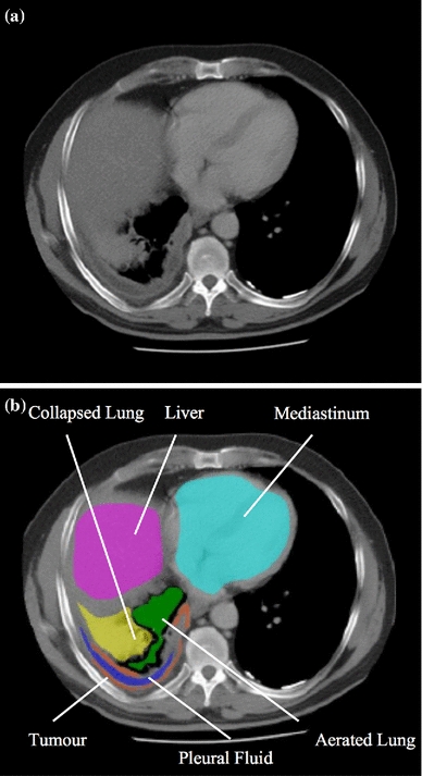 Computer-aided volumetric assessment of malignant pleural ...