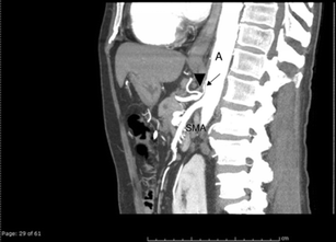 Image Findings in Celiac Artery Stenosis Due to Median Arcuate Ligament