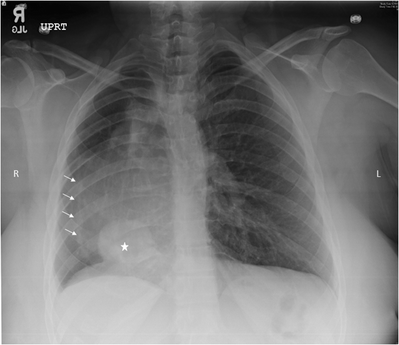 Scimitar Syndrome | SpringerLink