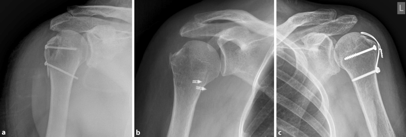 Anterior shoulder dislocation and concomitant fracture of ...