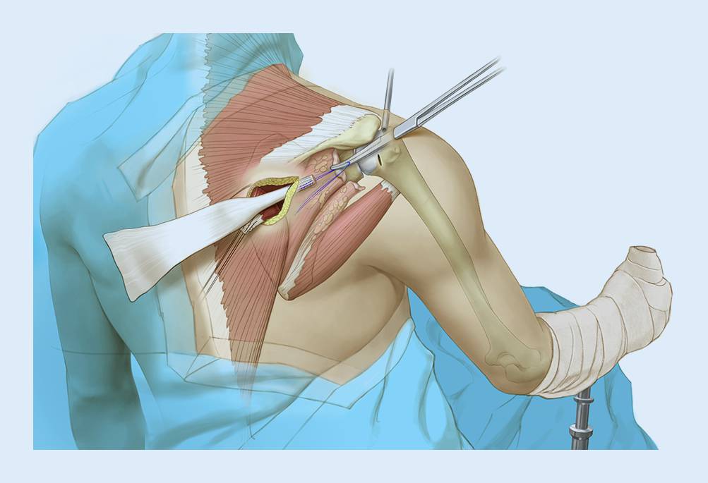 Lower trapezius transfer with Achilles tendon augmentation indication