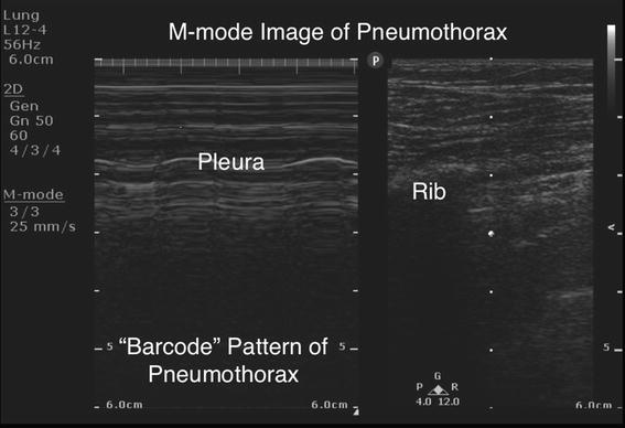 Ultrasound guided chest tube placement for basilar pneumothorax ...