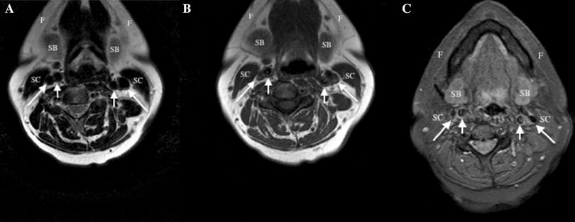 A vascular cause of neck pain | SpringerLink