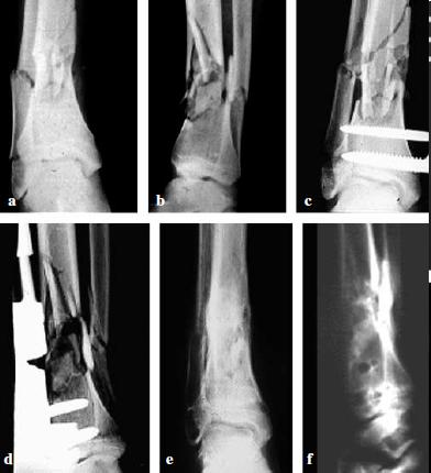 Distal tibial metaphyseal fractures: the role of fibular fixation