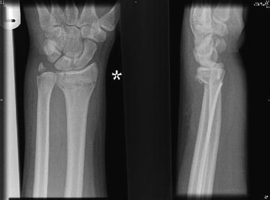 Distal radius fracture management in elderly patients a literature review