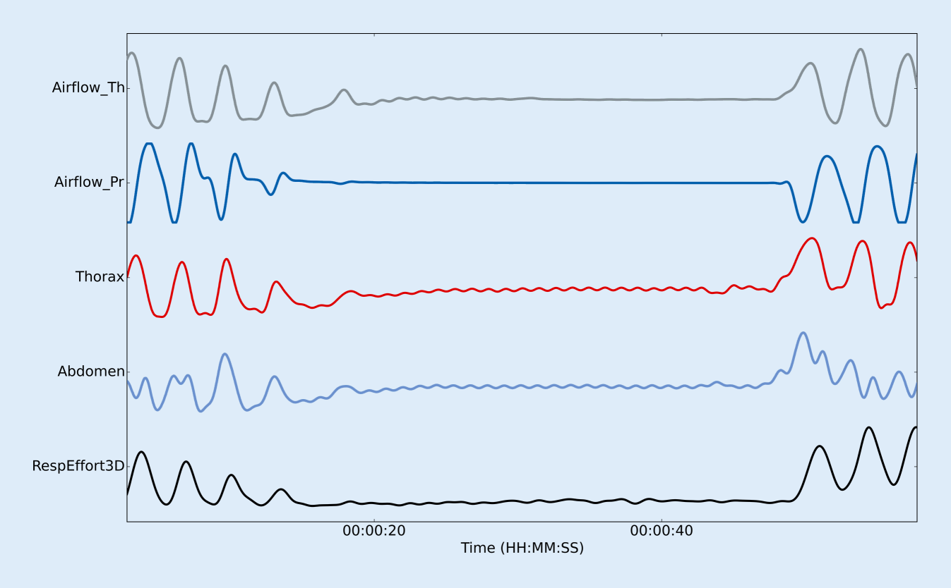 Measurement of respiratory effort in sleep by 3D camera and respiratory