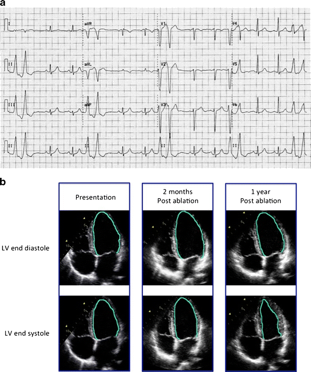 Heart Failure and TachycardiaInduced Cardiomyopathy SpringerLink