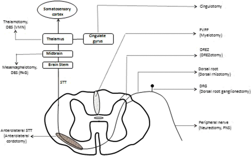 Surgical/Radiological Interventions for Cancer Pain | SpringerLink