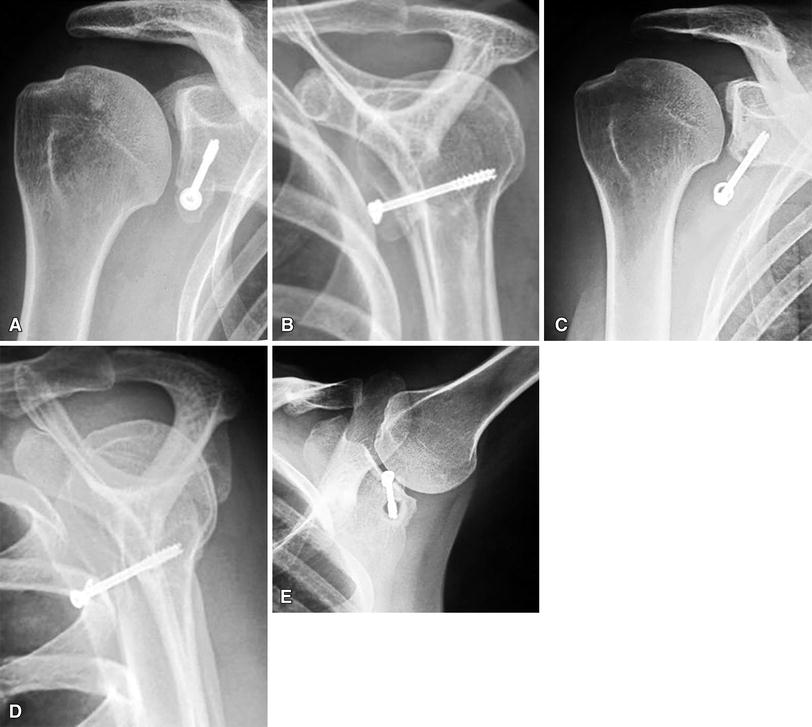 Arthroscopic BristowLatarjet Combined With Bankart Repair Restores Shoulder Stability in