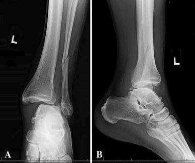 Classifications in Brief: Lauge-Hansen Classification of Ankle ...