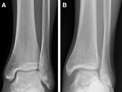 Syndesmosis injuries | SpringerLink