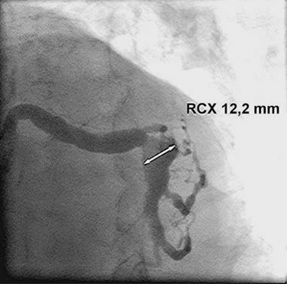 Akutes Koronarsyndrom bei koronarem Gigantismus | SpringerLink