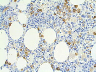 The AML–MDS interface—leukemic transformation in myelodysplastic ...