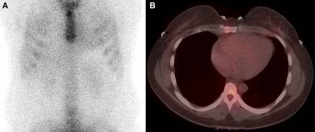 Nuclear imaging of cardiac amyloidosis | SpringerLink