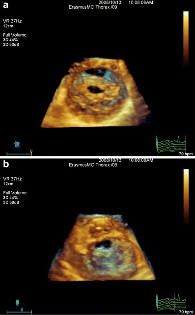 New Scores for the Assessment of Mitral Stenosis Using Real-Time Three
