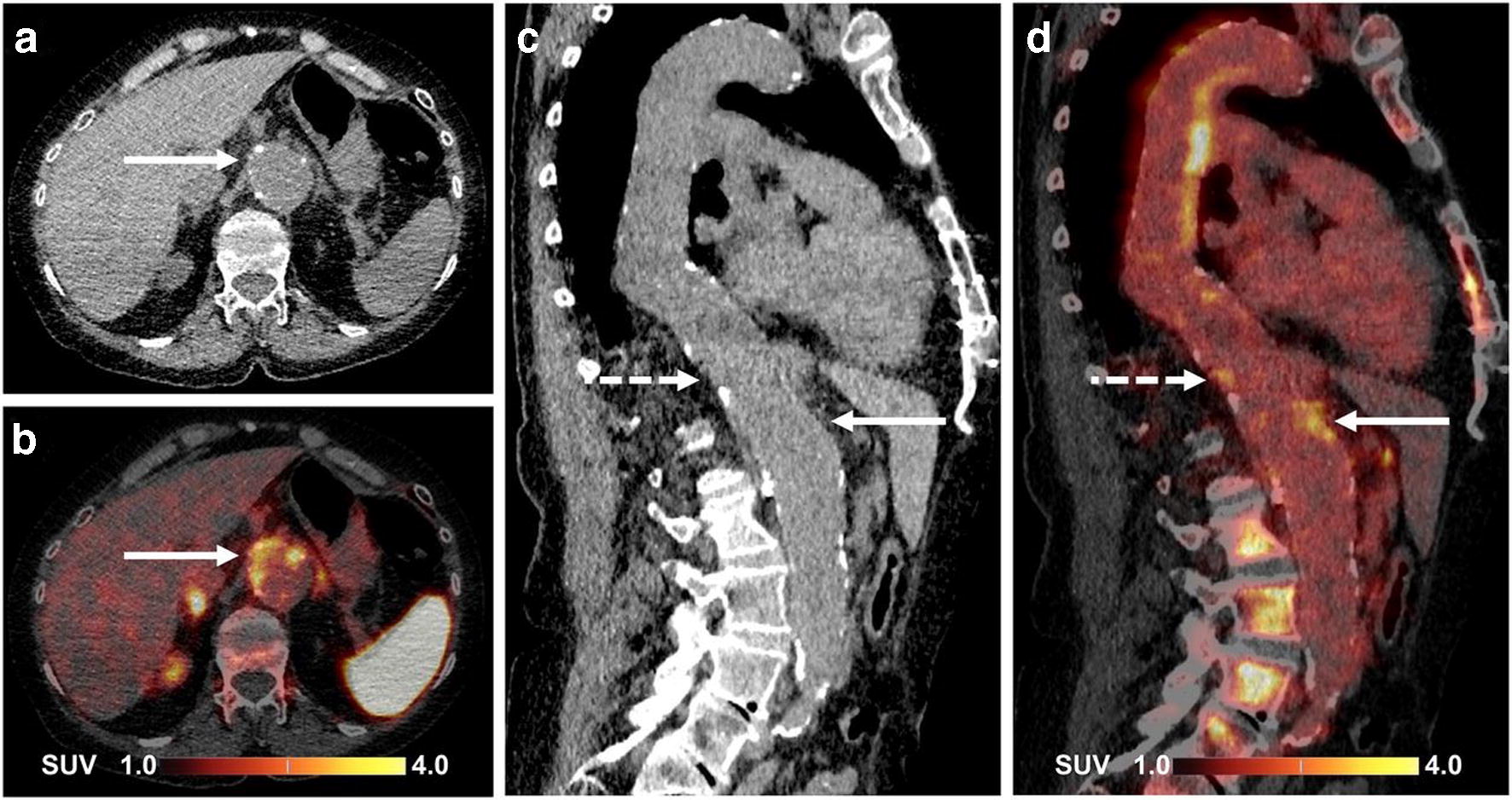 Radionuclide Imaging of Atherothrombotic Diseases SpringerLink
