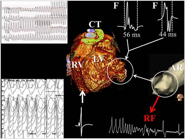 Endovascular catheter ablation of ventricular tachycardia in a patient with a surgically ...