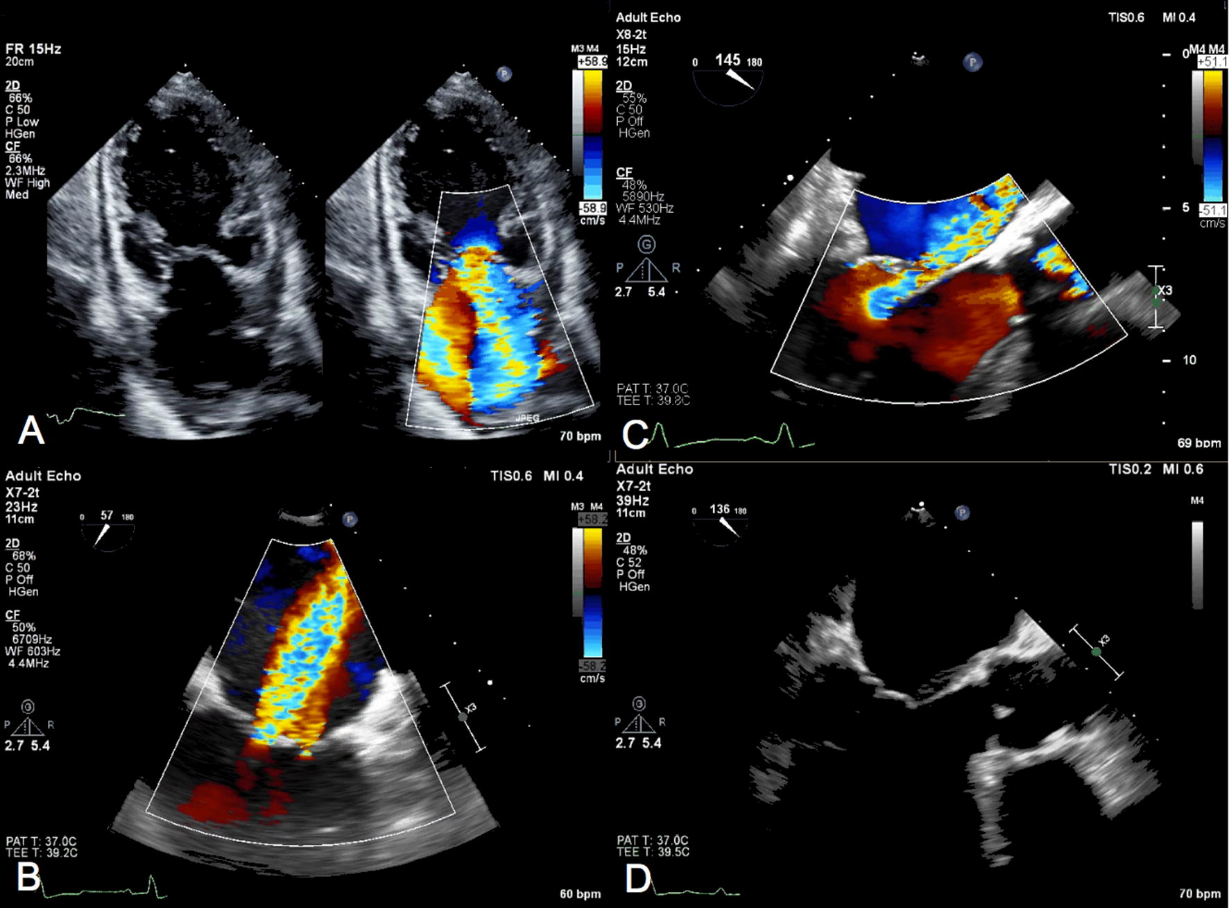 Echocardiographic guidance for transcatheter mitral valve repair using ...