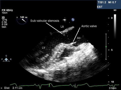Coronary left ventricular outflow tract fistula after resection of a ...