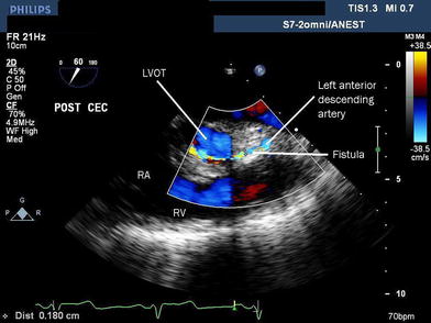 Coronary left ventricular outflow tract fistula after resection of a ...